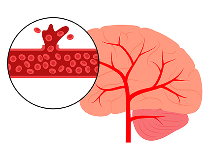 Diagram of a Hemorrhagic Stroke